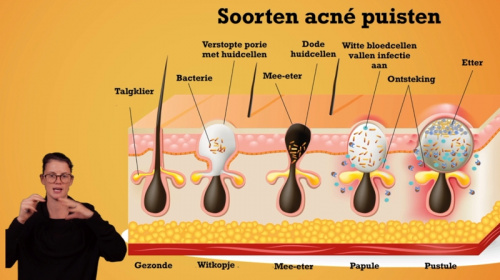 Video Gelaatsverzorging: acne of puisten -  2de graad