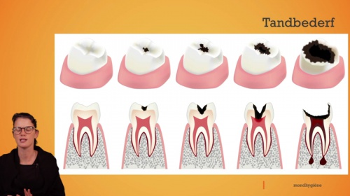 Video Mondhygiëne: tandbederf -  2de graad