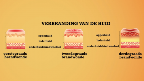 Video EHBO: brandwonde & verbranding van de huid - Mens & samenleving 1ste graad A